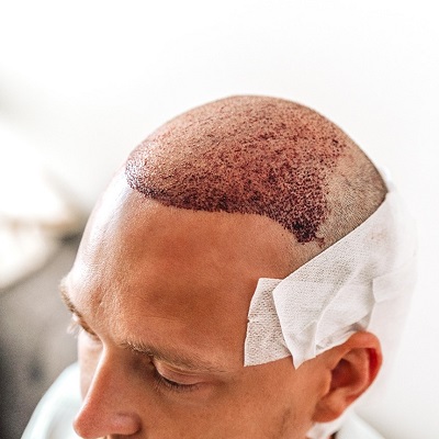 hair transplant in abu dhabi