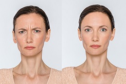 حقن البوتوكس في ابوظبي 5 before and after Botox abu dhabi