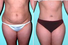 قبل وبعد علاج نحت الجسم في ابوظبي