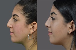 تجميل الانف في أبو ظبي قبل بعد