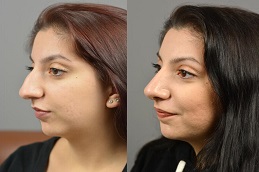 تجميل الانف في أبو ظبي قبل وبعد