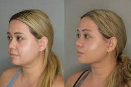 شفط دهون الذقن المزدوج 8 شفط دهون الذقن المزدوج في أبو ظبي قبل بعد