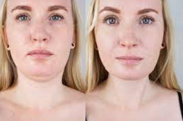 شفط دهون الذقن المزدوج في أبو ظبي قبل وبعد