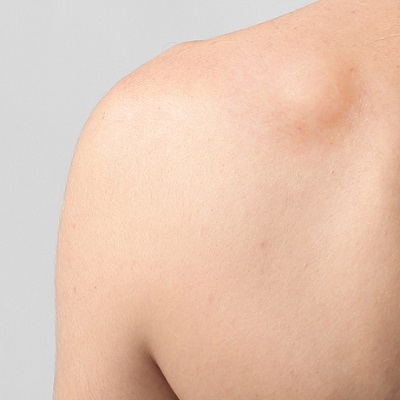 علاج الورم الشحمي 1 علاج الورم الشحمي في أبو ظبي