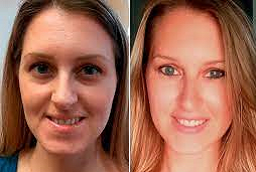 بيلوتيرو فيلر 8 بيلوتيرو فيلر في أبوظبي قبل بعد