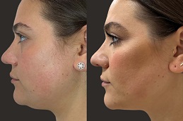 حقن إذابة الدهون في أبو ظبي قبل بعد