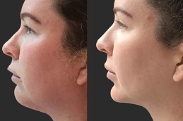 حقن إذابة الدهون في أبو ظبي قبل وبعد