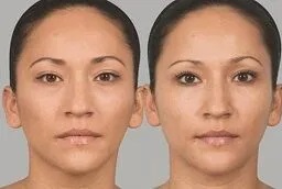 سكلبترا فيلر في أبو ظبي قبل بعد