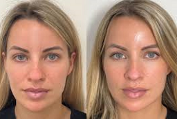 سكلبترا فيلر في أبو ظبي قبل وبعد