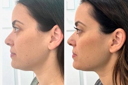 قبل وبعد حقن إذابة الدهون في أبو ظبي