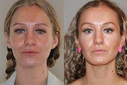 قبل وبعد سكلبترا فيلر في أبو ظبي