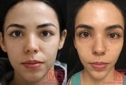 علاج ديرمابين في أبوظبي قبل وبعد