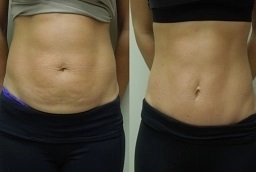 عملية شد البطن المصغرة 8 عملية شد البطن المصغرة في أبو ظبي قبل بعد