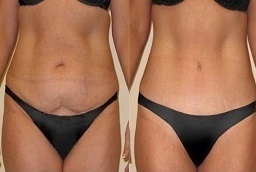 عملية شد البطن المصغرة في أبو ظبي قبل وبعد