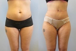 قبل وبعد عملية شد البطن المصغرة في أبو ظبي