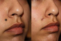 إزالة الشامات في أبوظبي قبل بعد