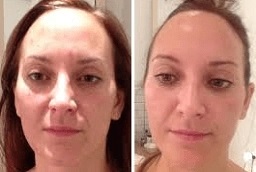 العلاج بالضوء LED في أبو ظبي قبل وبعد