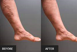 جراحة الأوعية الدموية في أبو ظبي قبل وبعد