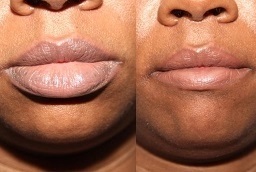 جراحة تصغير الشفاه في أبو ظبي قبل وبعد