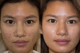 قبل وبعد العلاج بالضوء LED في أبو ظبي