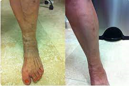 قبل وبعد جراحة الأوعية الدموية في أبو ظبي