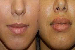 قبل وبعد جراحة تصغير الشفاه في أبو ظبي