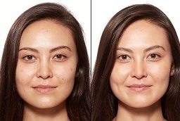 تبييض البشرة في أبو ظبي قبل بعد