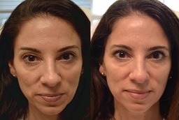 جراحة الجفون | تجميل الجفن 8 جراحة الجفون في أبوظبي قبل بعد