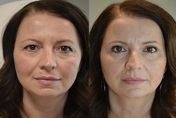 جراحة الجفون في أبوظبي قبل وبعد