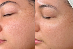 قبل وبعد علاج ديرما رولر في أبو ظبي