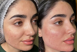 حقن ديسبورت في أبوظبي قبل بعد