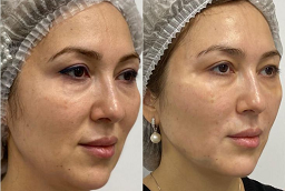 حقن ديسبورت في أبوظبي قبل وبعد