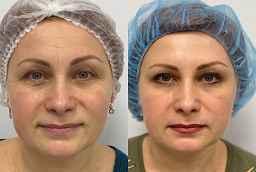 ريستيلين ليفت في أبوظبي قبل بعد