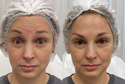 ريستيلين ليفت في أبوظبي قبل وبعد