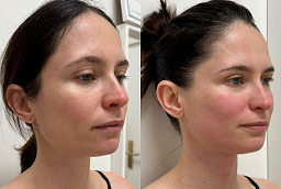 علاج الوخز بالإبر الدقيقة بتقنية الترددات الراديوية الجزئية في أبو ظبي قبل بعد