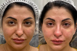 قبل وبعد ريستيلين ليفت في أبوظبي