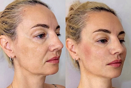 علاجات الليزر في أبوظبي قبل بعد