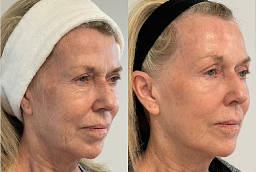 قبل وبعد علاجات الليزر في أبوظبي