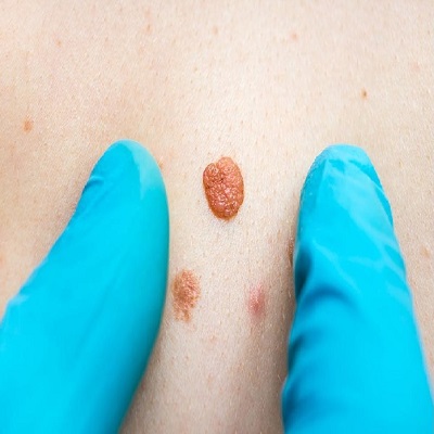 علاج إزالة الثآليل في أبوظبي