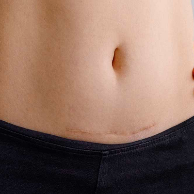 إزالة الندبات بالليزر في أبوظبي