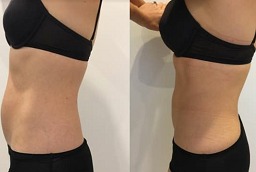 صور قبل وبعد العلاج بتقنية ليبوسونيكس