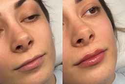 صور قبل وبعد حقن الفيلر للشفتين
