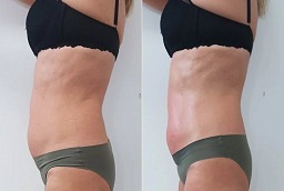 علاج ليبوسونيكس بعد و قبل