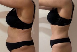 علاج ليبوسونيكس قبل وبعد