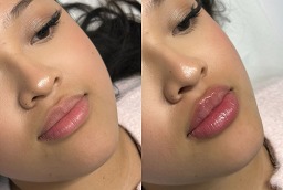 حقن فيلر الشفاه 8 قبل وبعد حقن الفيلر في الشفاه