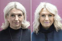 8 Point Fcaelift in Abu Dhabi & Al Ain