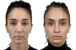 8 Point Fcaelift in Abu Dhabi