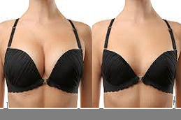 AFT Breast Augmentation 5 AFT Bteast augmentation
