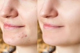 Acne Treatment 5 Acne-Treatment-Clinic-in-Abu-Dhabi