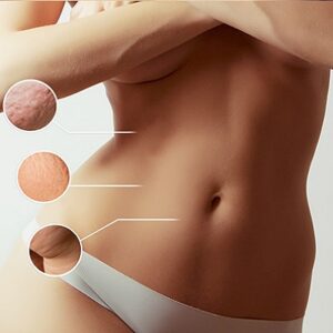 Affordable-Liposuction in Abu Dhabi Al Ain Liposuction Cost